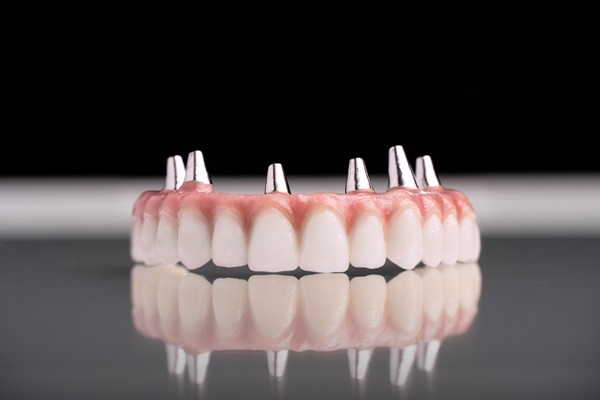 Implant Supported Dentures: Can They Successfully Replace Upper Teeth?